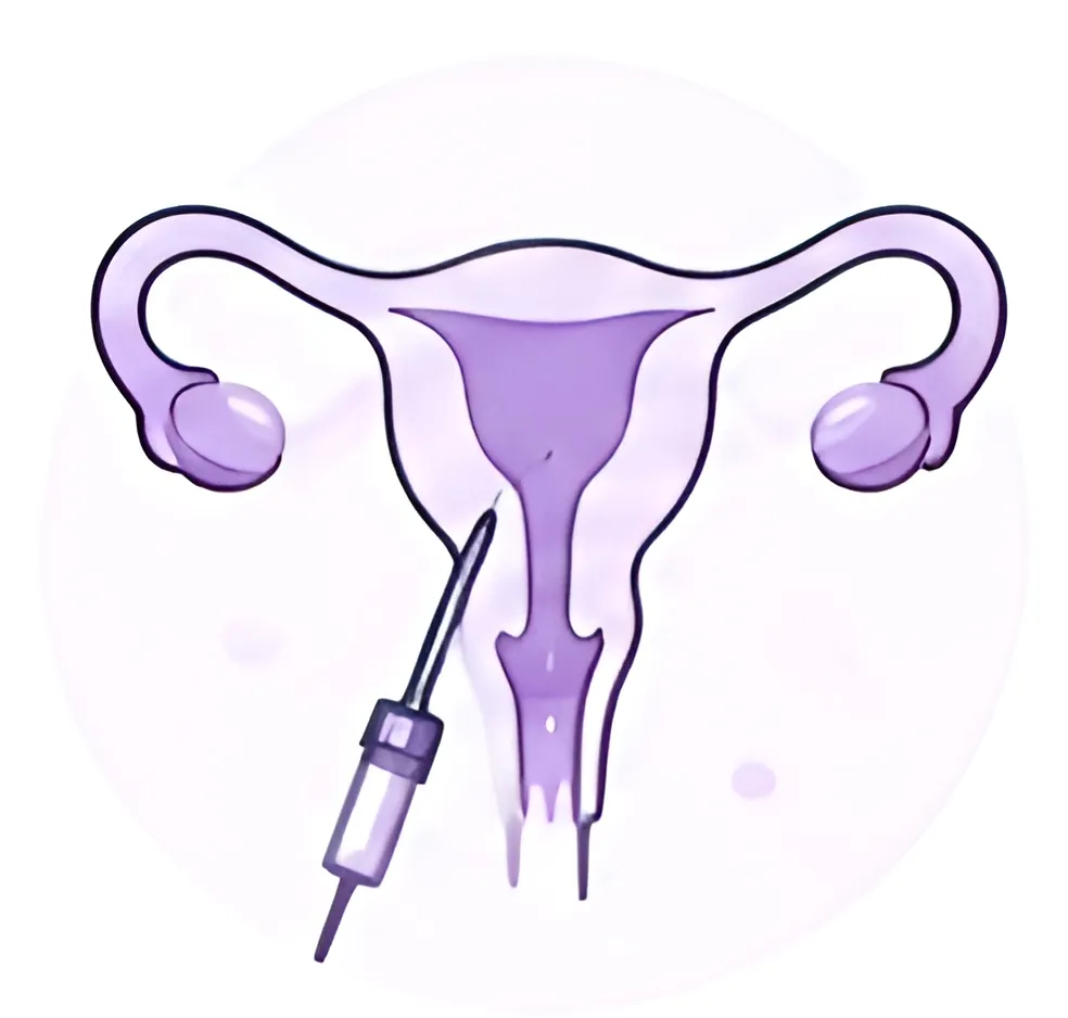 Intrauterine Insemination (IUI)